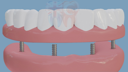 Full Mouth Dental Implants | A New Era of Smiles